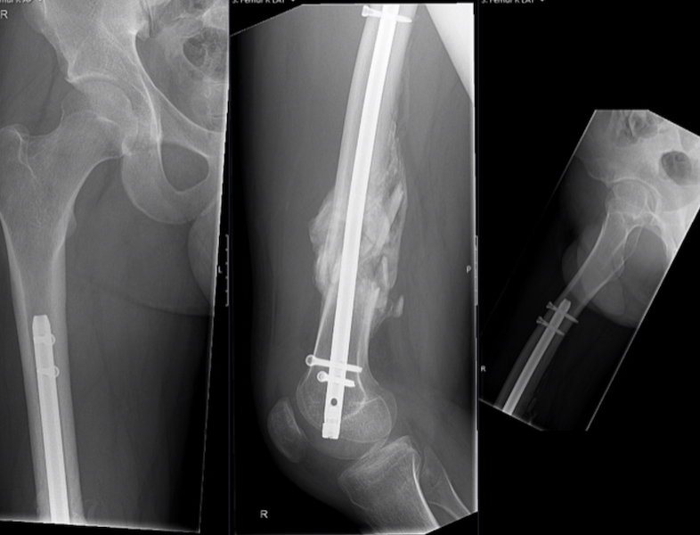 Smith & Nephew TriGen Retrograde Femoral Nail (Implant 200524)